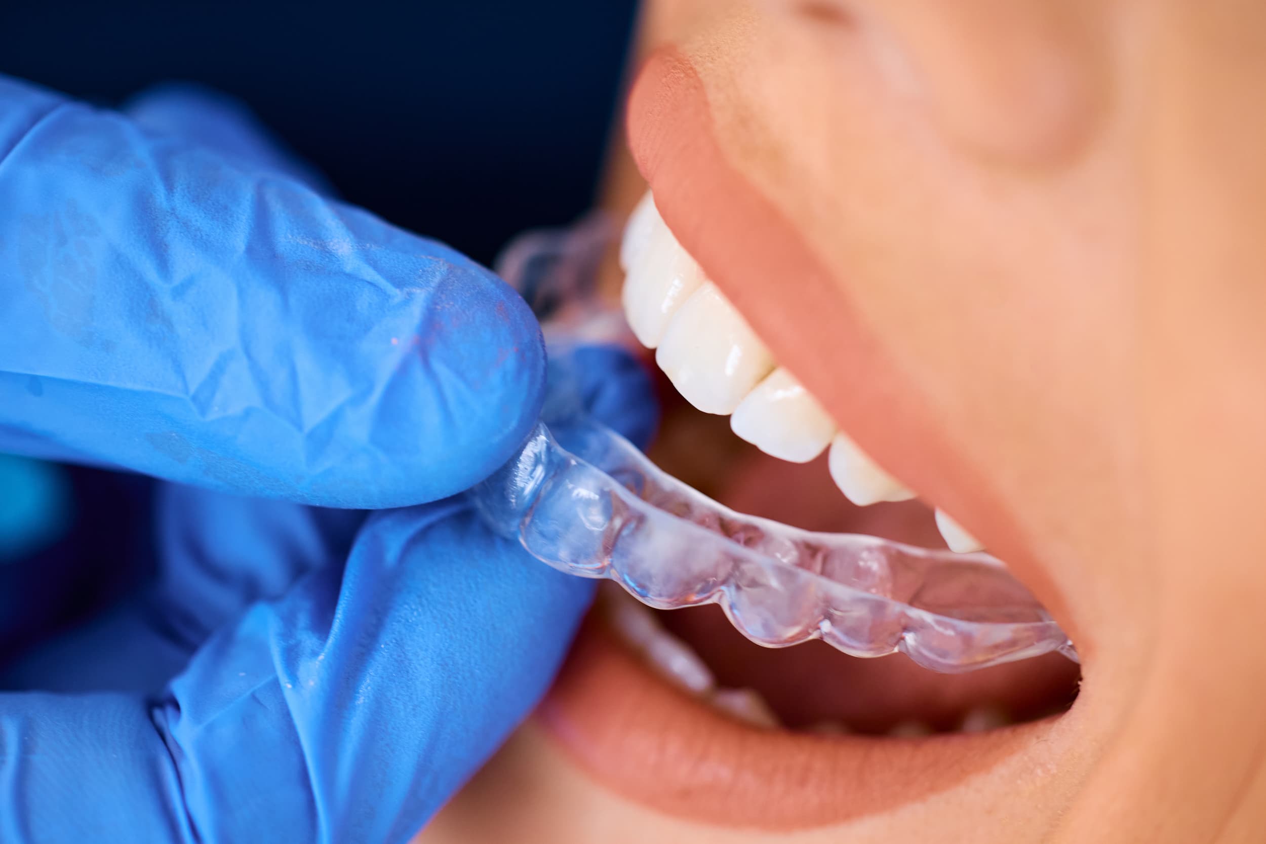 Dentist fitting clear aligners on patient at Exquisite Smiles Warner