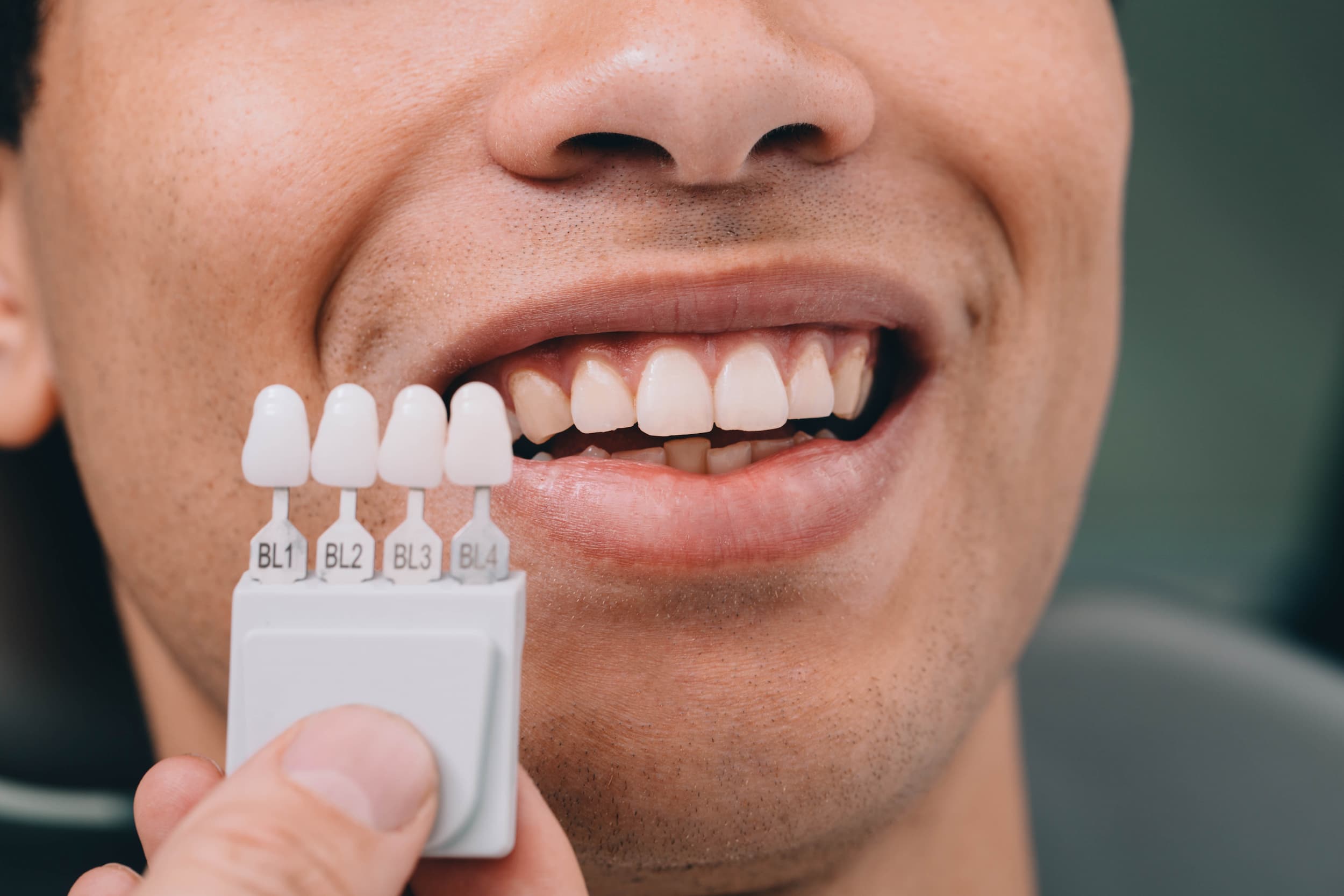 Comparing male’s teeth to dental shade palette for veneers